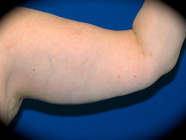 Arm Lift before and after - after