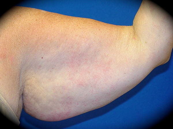 Arm Lift before and after - before