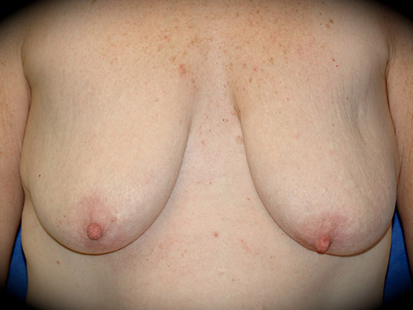 Breast Augmentation with Mastopexy before and after - before