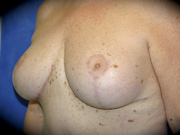 Breast Reduction before and after - after