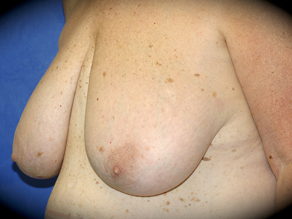 Breast Reduction before and after - before
