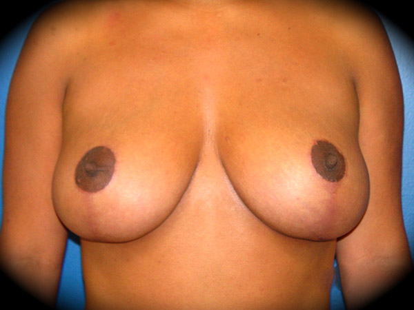 Breast Lift before and after - after