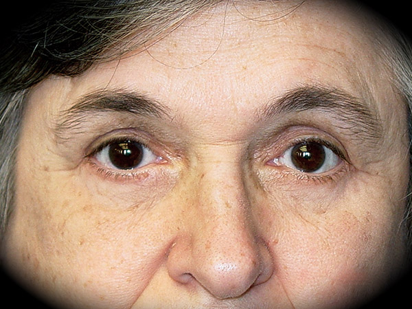 Brow Lift before and after - after