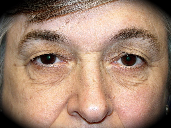 Brow Lift before and after - before