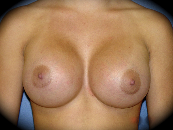 Breast Augmentation before and after - after