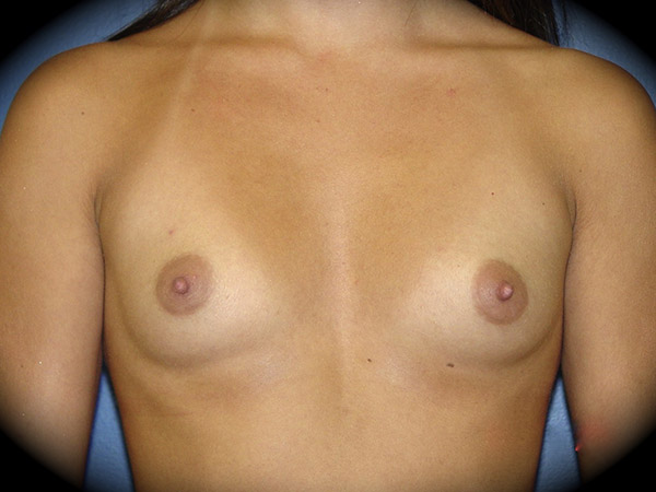 Breast Augmentation before and after - before
