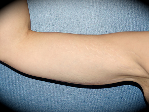 Arm Lift before and after - after