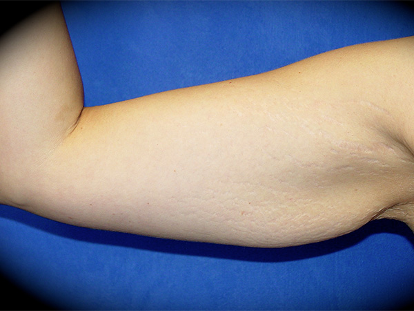 Arm Lift before and after - before