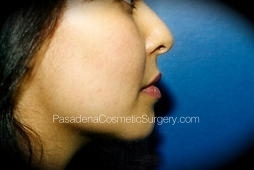 Chin Augmentation before and after - after