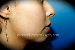 Chin Augmentation before and after - before
