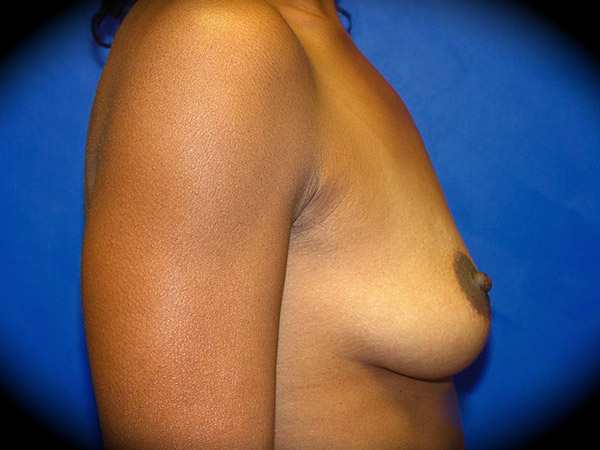Breast Augmentation before and after - before