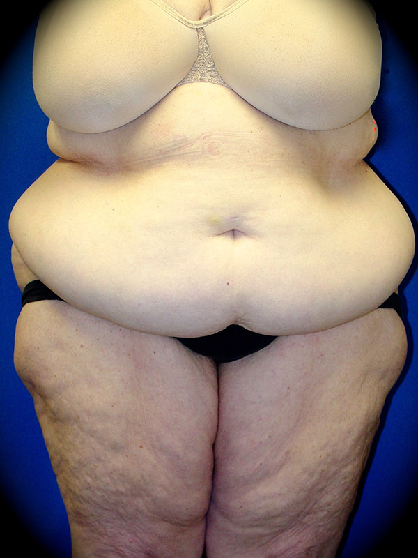 Body Lift before and after - before