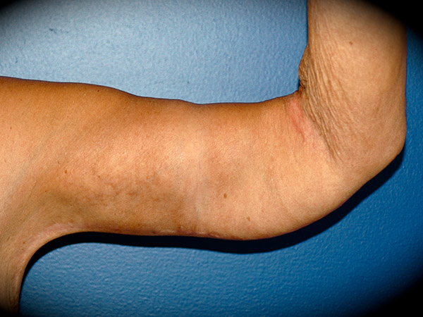 Arm Lift before and after - after