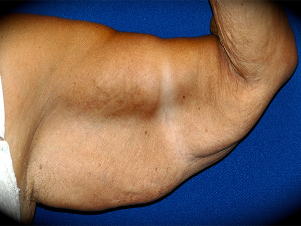 Arm Lift before and after - before