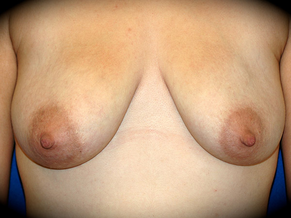 Breast Augmentation with Mastopexy before and after - before
