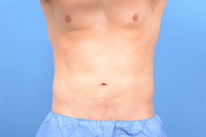 Liposuction before and after - after