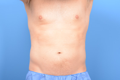 Liposuction before and after - before