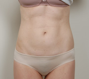 Liposuction before and after - after