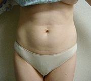 Liposuction before and after - before