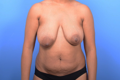 Mommy Makeover before and after - before