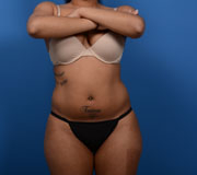 Liposuction before and after - before