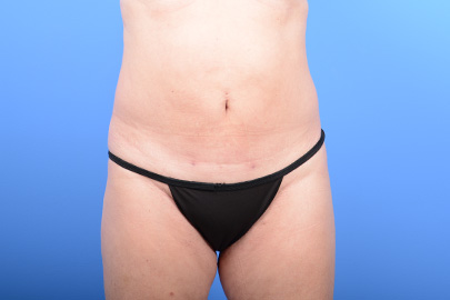 Liposuction before and after - after