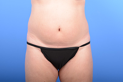 Liposuction before and after - before