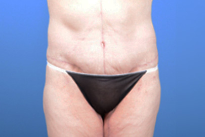 Lower Body Lift before and after - after