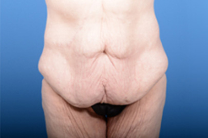 Lower Body Lift before and after - before