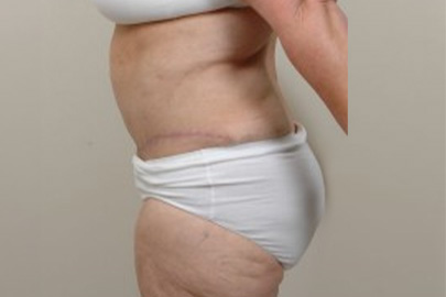 Panniculectomy before and after - after