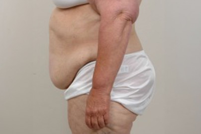 Panniculectomy before and after - before
