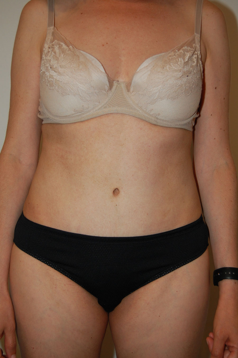 Procedure before and after - after