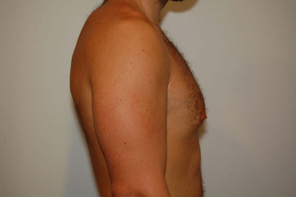 Procedure before and after - before