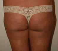 BBL before and after - before