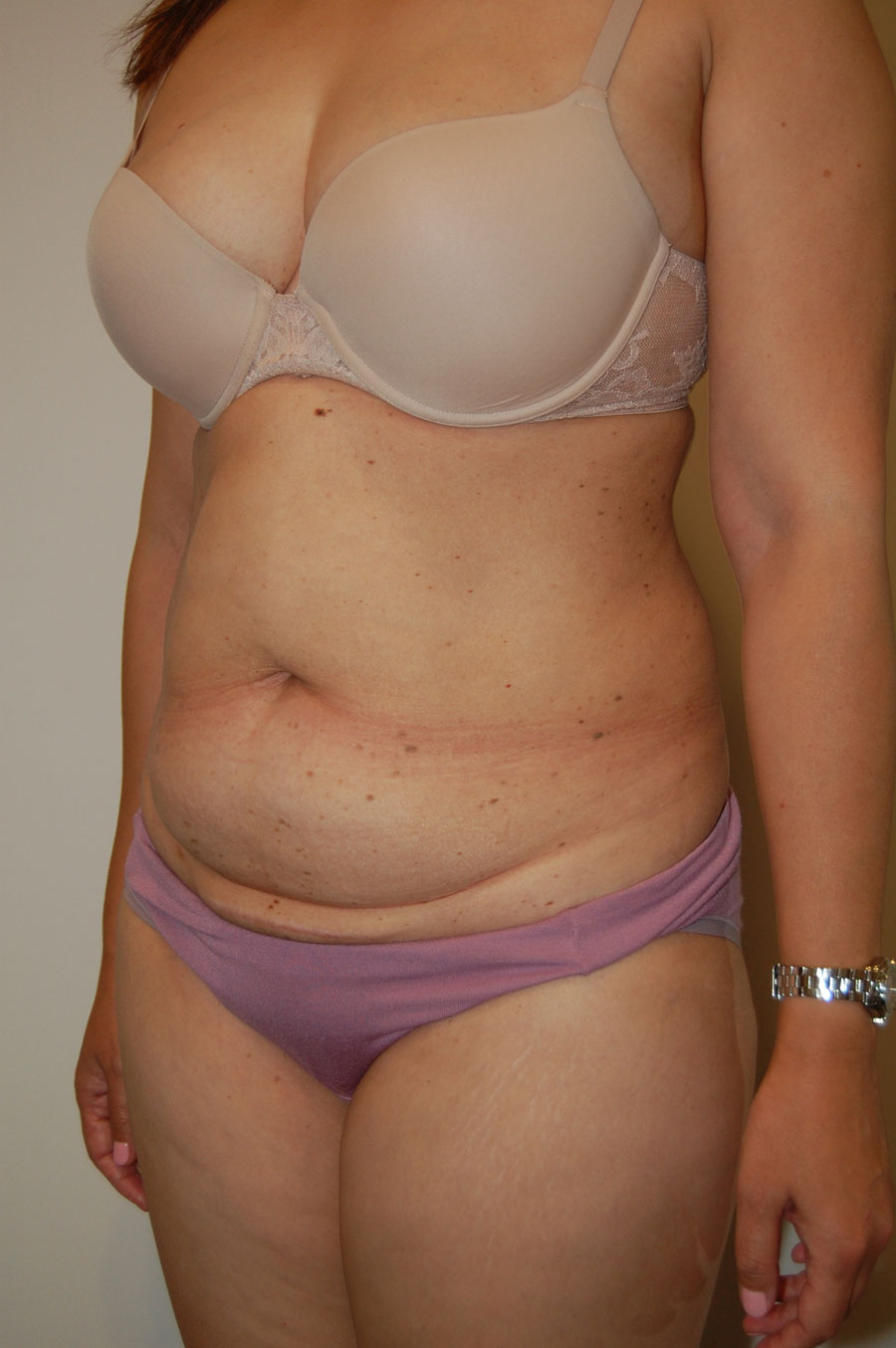 Procedure before and after - before