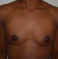 Breast Augmentation before — Dr. Charles Umansky
