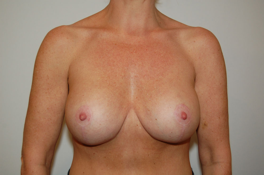 Procedure before and after - after