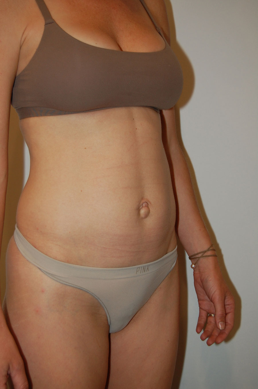 Procedure before and after - before