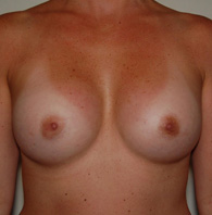 Breast Augmentation after — Dr. Charles Umansky