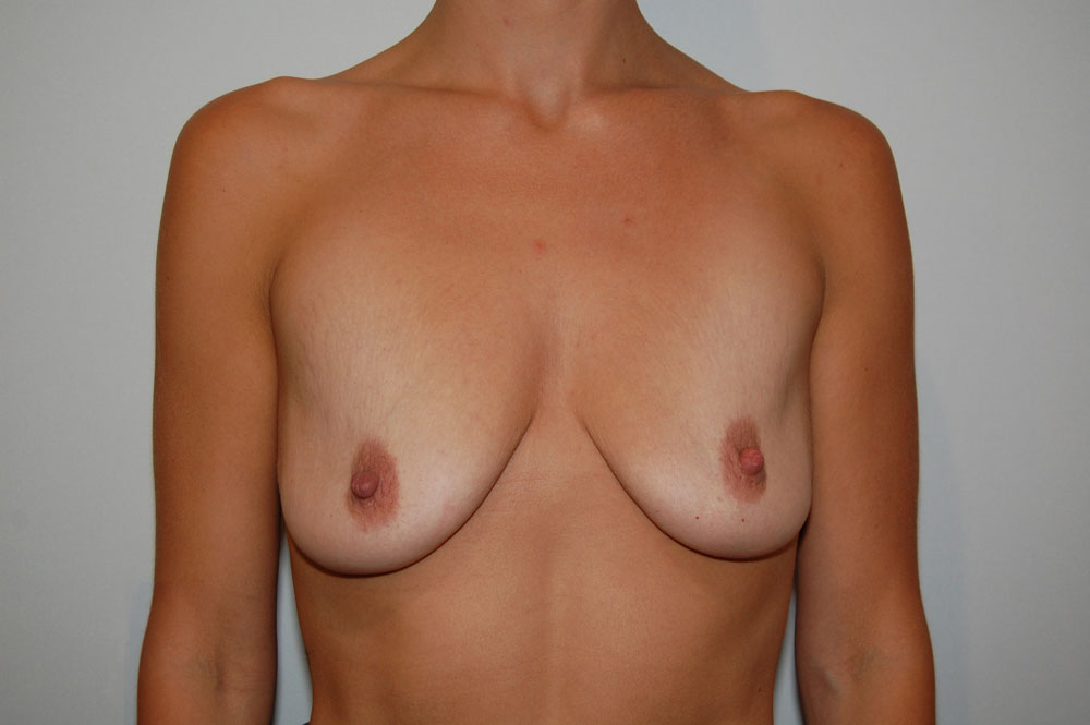 Breast Augmentation before — Dr. Charles Umansky