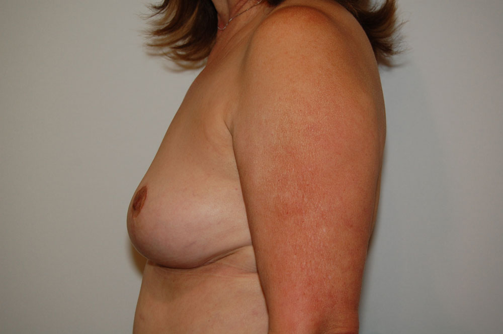 Breast Augmentation before and after - after