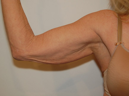 Procedure before and after - before