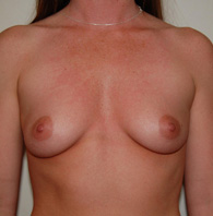 Breast Augmentation before — Dr. Charles Umansky