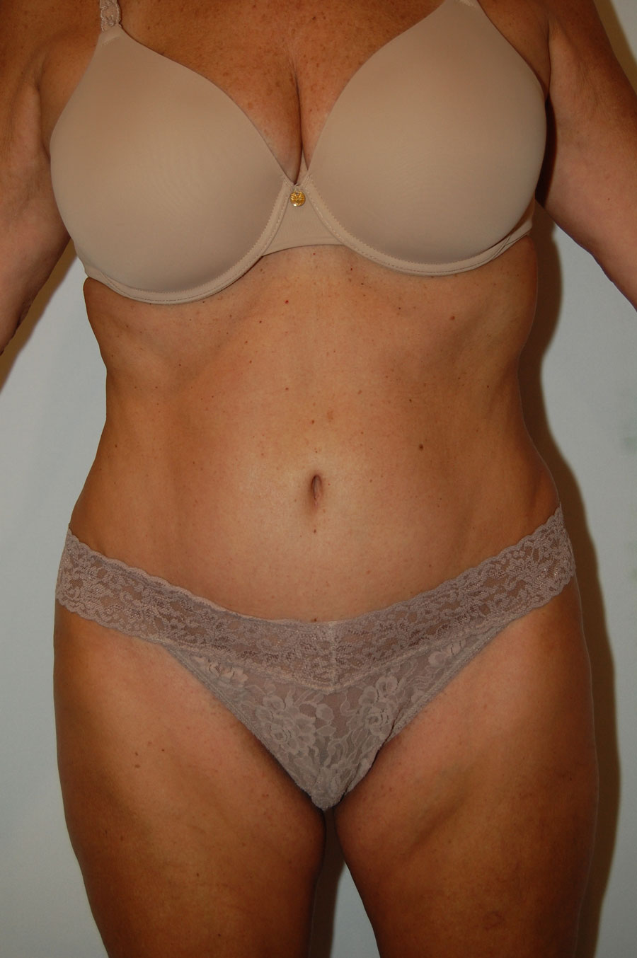 Procedure before and after - after