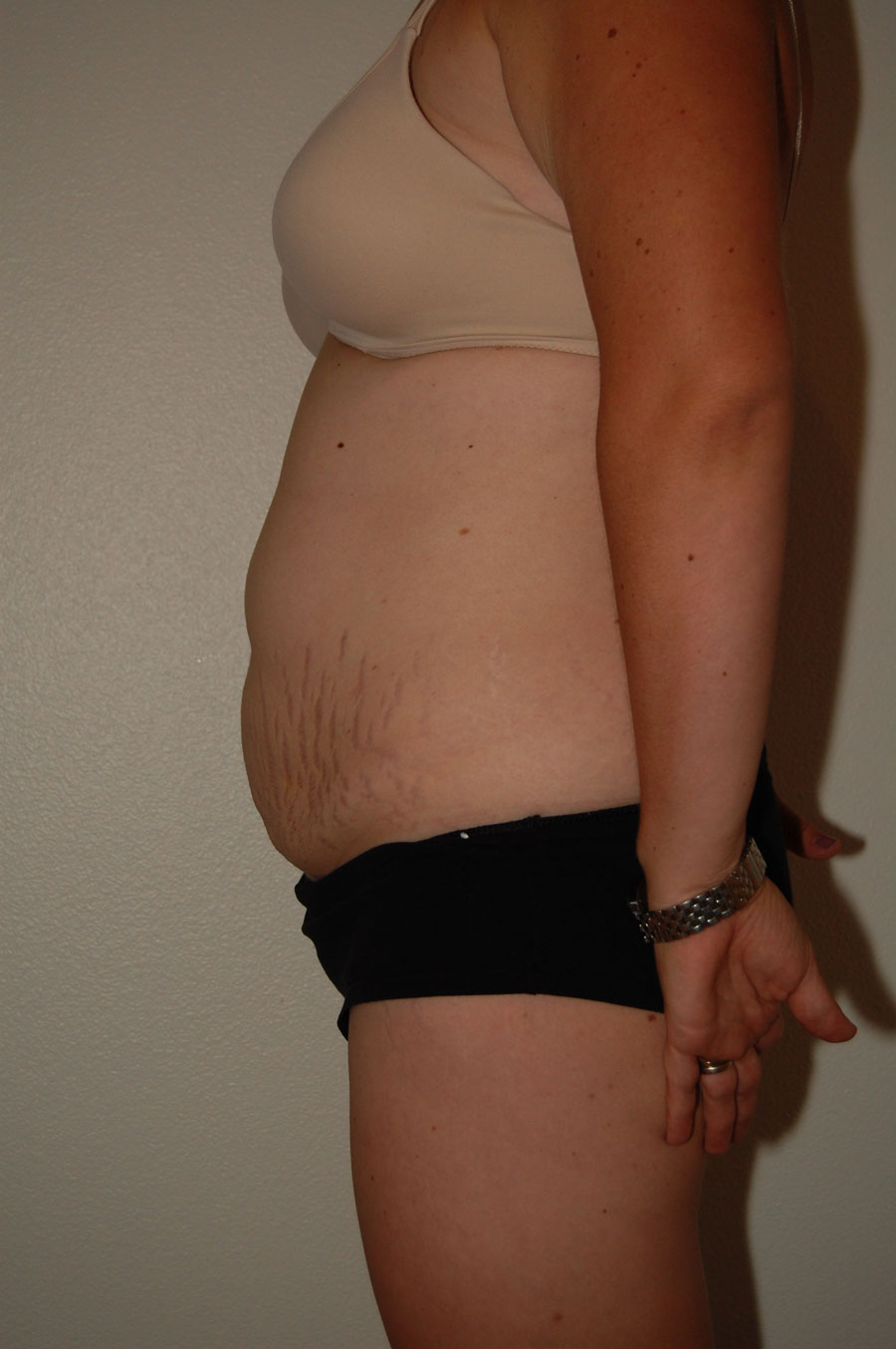 Procedure before and after - before