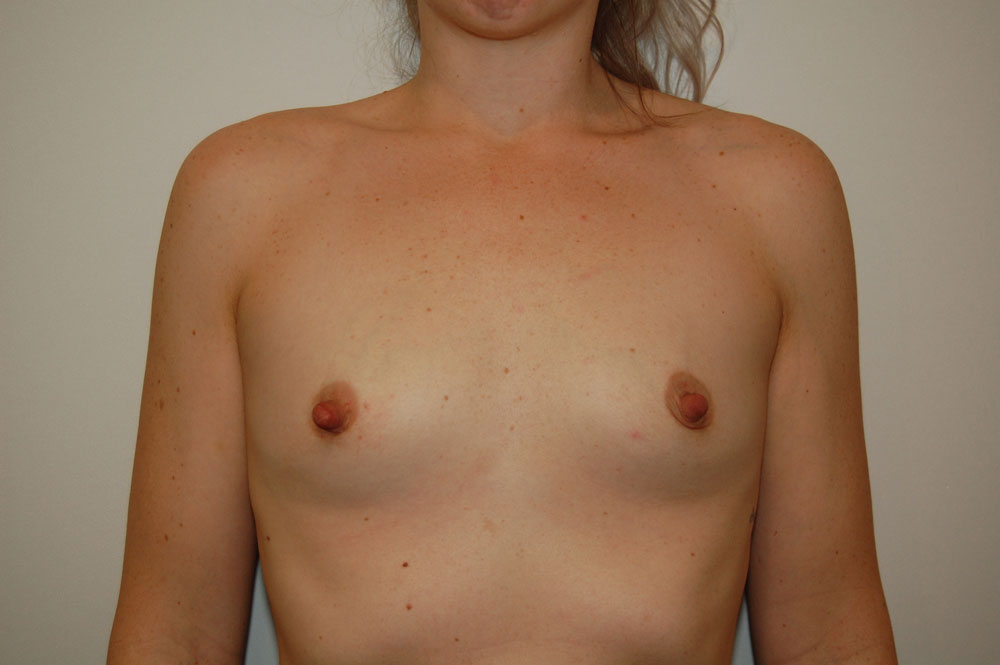 Breast Augmentation before — Dr. Charles Umansky
