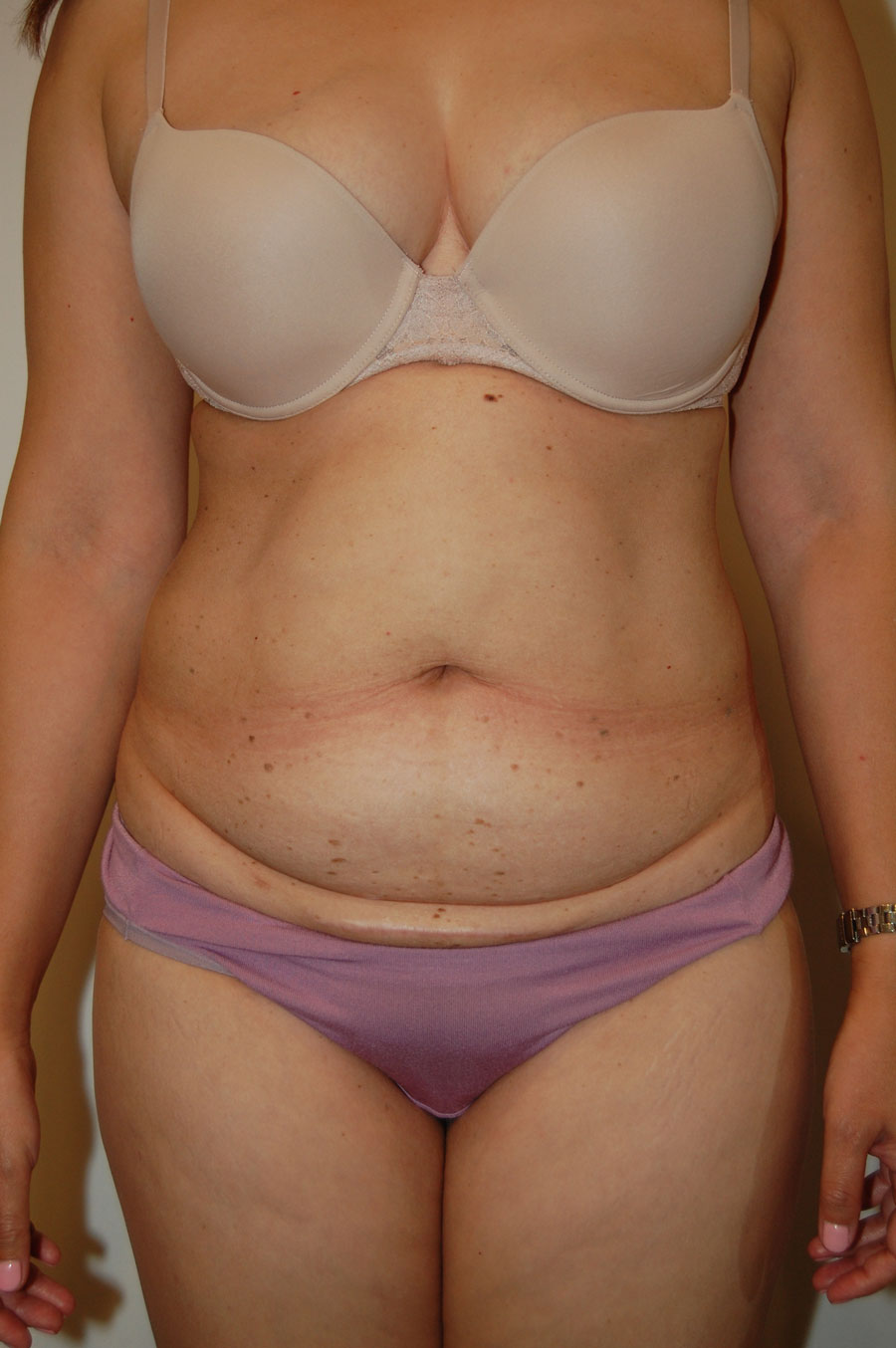 Procedure before and after - before