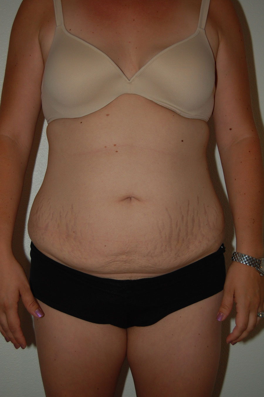 Procedure before and after - before