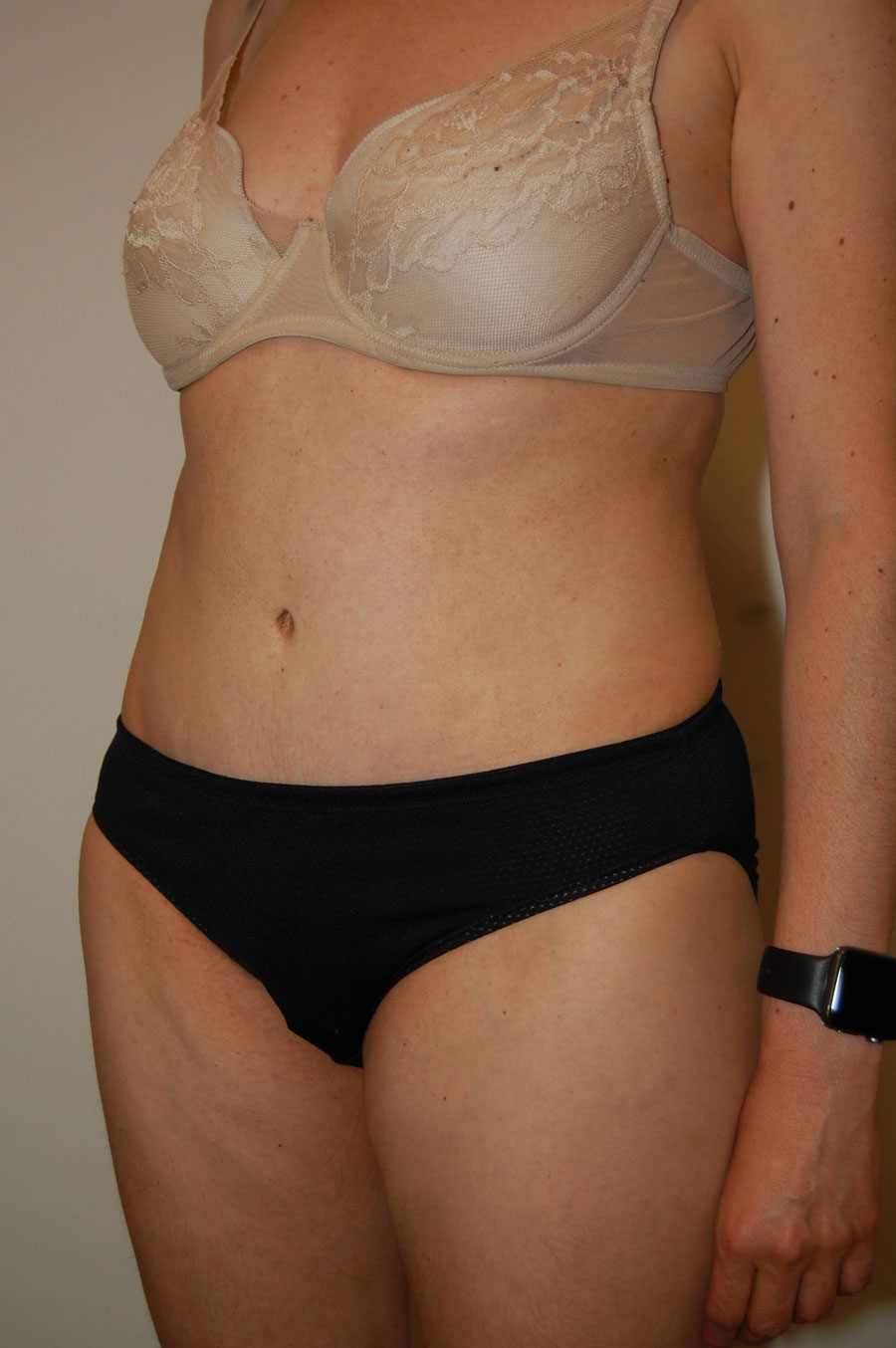 Procedure before and after - after
