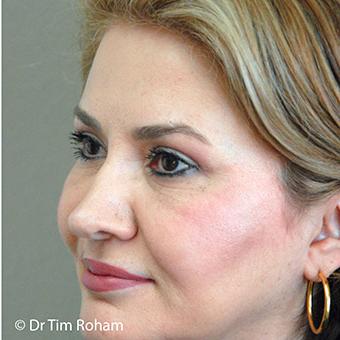 Blepharoplasty before and after - after